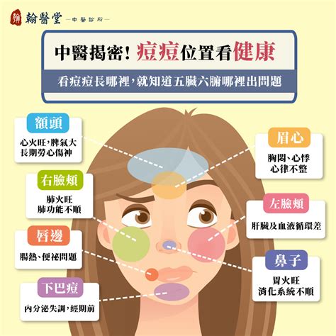 右臉頰|9種「痘痘位置」透露你的身體狀況！額頭冒痘可能是。